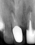 Inflammation under framtnder.